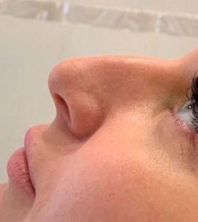 Контурная пластика носа - фото до