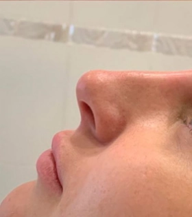 Контурная пластика носа - фото після