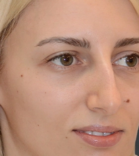 Контурная пластика носа - фото до