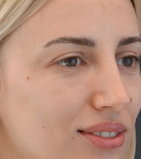 Контурная пластика носа - фото після