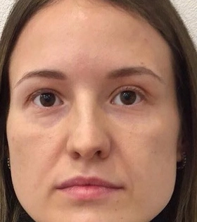 Коррекция носослезной борозды - фото до