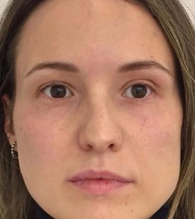 Коррекция носослезной борозды - фото після