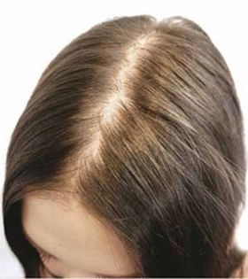 Мезотерапия для волос - фото до