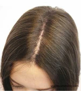 Мезотерапия для волос - фото після