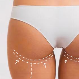 Глютеопластика 