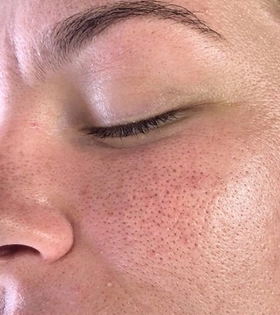 Ультразвукове чищення обличчя в Одесі. - фото до