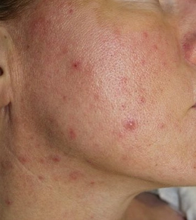 Комбинированная чистка лица в Одессе - фото до