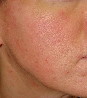 Комбинированная чистка лица в Одессе - фото после