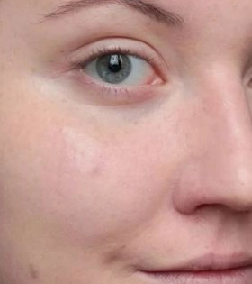 Атравматична глибока чистка обличчя в Одесі - фото після