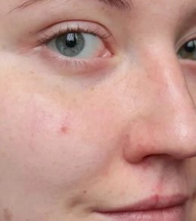 Атравматична глибока чистка шкіри обличчя - фото до