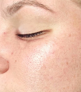 Ультразвукове чищення обличчя - фото після