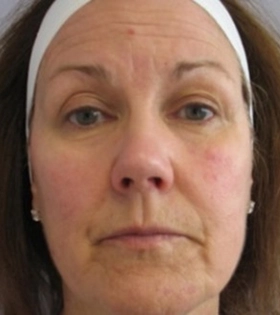 Карбокситерапия - фото до