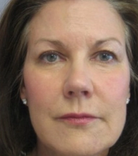 Карбокситерапия - фото після