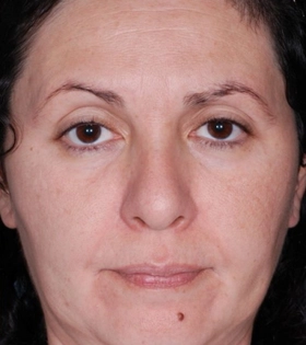 Пилинг ТСА - фото після