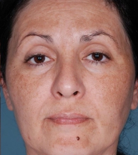 Пилинг ТСА - фото до