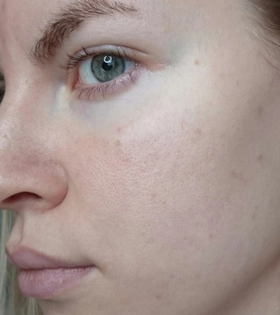 Пилинг PRX-T33 - фото до