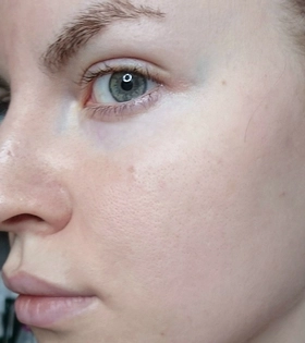 Пилинг PRX-T33 - фото після