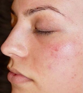 Пилинг PRX-T33 - фото до