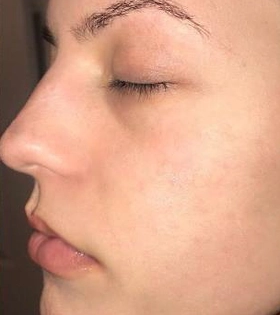 Пилинг PRX-T33 - фото після