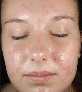 Пилинг Джесснера - фото до