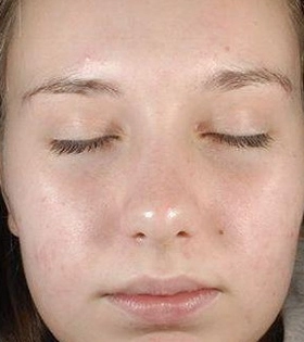 Пилинг Джесснера - фото після