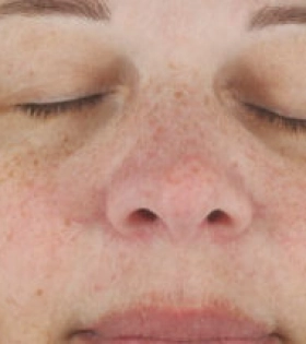 Пилинг Джесснера - фото до