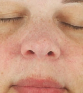 Пилинг Джесснера - фото після