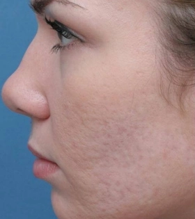 Пилинг Кемикум - фото до