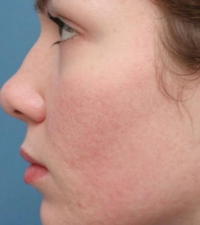 Пилинг Кемикум - фото після