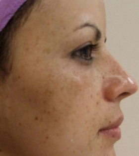 Пилинг Кемикум - фото до