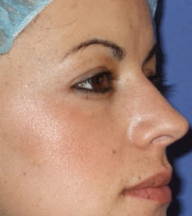 Пилинг Кемикум - фото після