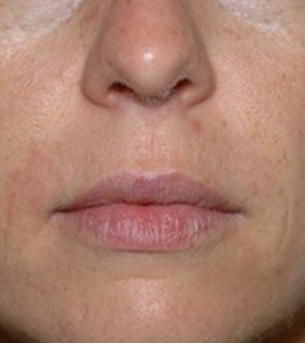 Липофилинг носогубных складок - фото після