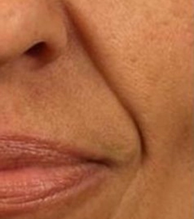 Липофилинг носогубных складок - фото до