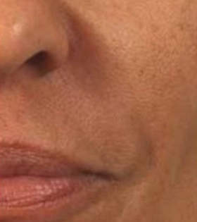 Липофилинг носогубных складок - фото після