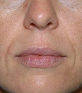 Липофилинг носогубных складок - фото до