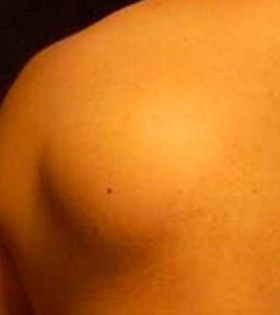 Удаление липомы - фото до