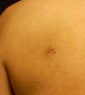 Удаление липомы - фото після