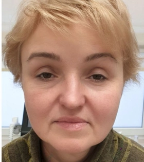 SMAS лифтинг, врач Максюта О.А. - фото до