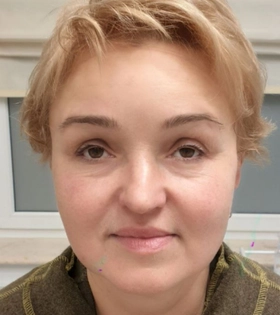 SMAS лифтинг, врач Максюта О.А. - фото після