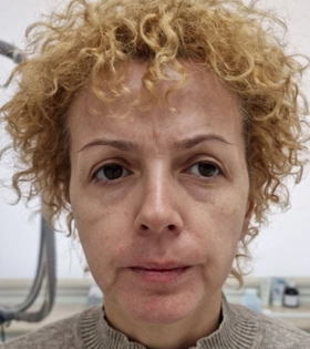 SMAS лифтинг, врач Максюта О.А. - фото до