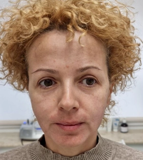 SMAS лифтинг, врач Максюта О.А. - фото після