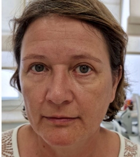 SMAS лифтинг, врач Максюта О.А. - фото до