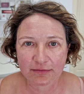 SMAS лифтинг, врач Максюта О.А. - фото після