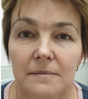 SMAS лифтинг, врач Максюта О.А. - фото до