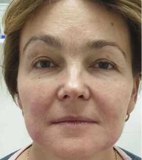 SMAS лифтинг, врач Максюта О.А. - фото після