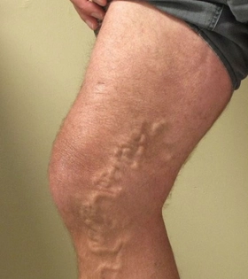 Лечение варикоза  - фото до