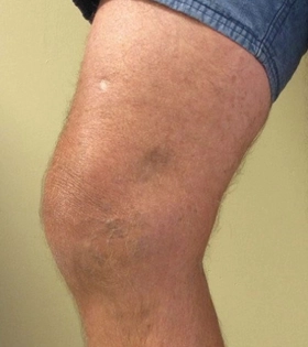 Лазерное лечение варикоза - фото після