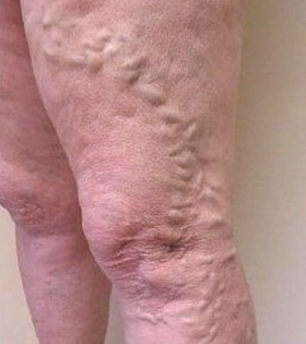 Лазерное лечение варикоза - фото до