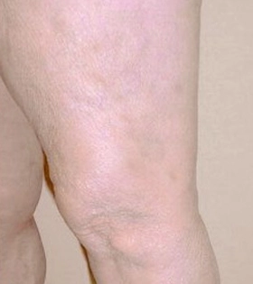 Лазерное лечение варикоза - фото після