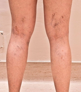 Склеротерапия - фото до